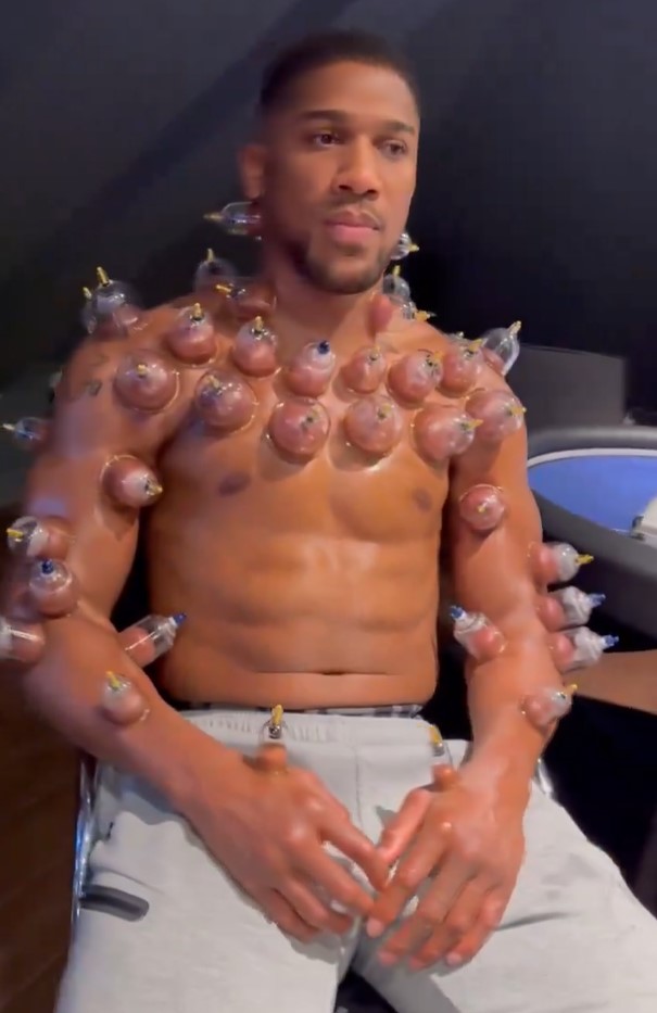 Anthony Joshua is preparing for his next fight with 'hot cupping'